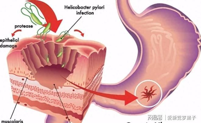 IM电竞柳叶刀：幽门螺杆菌是中国胃癌最大的祸根牢记4个办法彻底杀菌(图5)